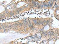 Immunohistochemistry of paraffin-embedded Human colorectal cancer tissue using PAFAH1B3 Polyclonal Antibody at dilution of 1:60 (×200)