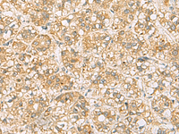 Immunohistochemistry of paraffin-embedded Human liver cancer tissue using FAAP100 Polyclonal Antibody at dilution of 1:65 (×200)