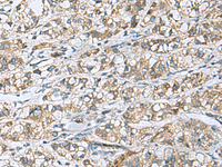 Immunohistochemistry of paraffin-embedded Human liver cancer tissue using DNAJA4 Polyclonal Antibody at dilution of 1:50 (×200)