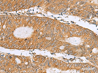 Immunohistochemistry of paraffin-embedded Human colorectal cancer tissue using DNAJA4 Polyclonal Antibody at dilution of 1:50 (×200)