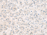 Immunohistochemistry of paraffin-embedded Human liver cancer tissue using ANKS6 Polyclonal Antibody at dilution of 1:55 (×200)