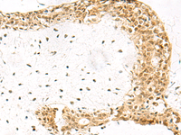 Immunohistochemistry of paraffin-embedded Human breast cancer tissue using EXOSC4 Polyclonal Antibody at dilution of 1:70 (×200)