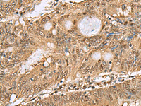 Immunohistochemistry of paraffin-embedded Human colorectal cancer tissue using PSMA6 Polyclonal Antibody at dilution of 1:65 (×200)