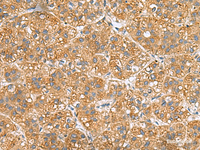 Immunohistochemistry of paraffin-embedded Human liver cancer tissue using PPM1M Polyclonal Antibody at dilution of 1:50 (×200)