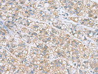 Immunohistochemistry of paraffin-embedded Human liver cancer tissue using NANP Polyclonal Antibody at dilution of 1:50 (×200)