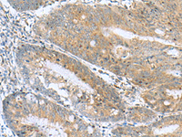 Immunohistochemistry of paraffin-embedded Human colorectal cancer tissue using NANP Polyclonal Antibody at dilution of 1:50 (×200)