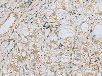 Immunohistochemistry of paraffin-embedded Human liver cancer tissue using RAB3IP Polyclonal Antibody at dilution of 1:60 (×200)