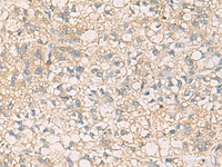 Immunohistochemistry of paraffin-embedded Human liver cancer tissue using STX6 Polyclonal Antibody at dilution of 1:45 (×200)