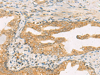 Immunohistochemistry of paraffin-embedded Human prost ate cancer tissue using STX6 Polyclonal Antibody at dilution of 1:45 (×200)