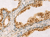 Immunohistochemistry of paraffin-embedded Human prost ate cancer tissue using ELF5 Polyclonal Antibody at dilution of 1:75 (×200)