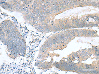 Immunohistochemistry of paraffin-embedded Human colorectal cancer tissue using KRCC1 Polyclonal Antibody at dilution of 1:60 (×200)
