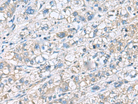 Immunohistochemistry of paraffin-embedded Human liver cancer tissue using KRCC1 Polyclonal Antibody at dilution of 1:60 (×200)