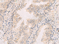 Immunohistochemistry of paraffin-embedded Human prost at e cancer tissue using TNNT1 Polyclonal Antibody at dilution of 1:35 (×200)