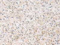 Immunohistochemistry of paraffin-embedded Human liver cancer tissue using TNNT1 Polyclonal Antibody at dilution of 1:35 (×200)