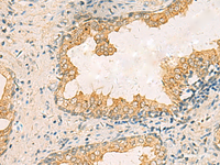 Immunohistochemistry of paraffin-embedded Human prost ate cancer tissue using HORMAD2 Polyclonal Antibody at dilution of 1:35 (×200)