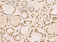 Immunohistochemistry of paraffin-embedded Human thyroid cancer tissue using SAP30BP Polyclonal Antibody at dilution of 1:45 (×200)