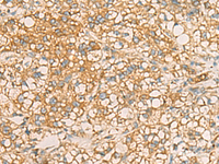 Immunohistochemistry of paraffin-embedded Human liver cancer tissue using AIMP1 Polyclonal Antibody at dilution of 1:40 (×200)