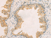 Immunohistochemistry of paraffin-embedded Human prost ate cancer tissue using AIMP1 Polyclonal Antibody at dilution of 1:40 (×200)