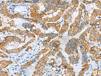 Immunohistochemistry of paraffin-embedded Human thyroid cancer tissue using FBXO8 Polyclonal Antibody at dilution of 1:40 (×200)