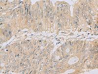 Immunohistochemistry of paraffin-embedded Human colorectal cancer tissue using TSTA3 Polyclonal Antibody at dilution of 1:80 (×200)