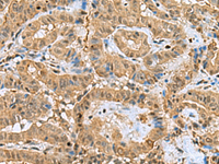 Immunohistochemistry of paraffin-embedded Human thyroid cancer tissue using PTPA Polyclonal Antibody at dilution of 1:60 (×200)