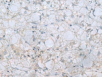 Immunohistochemistry of paraffin-embedded Human liver cancer tissue using NAGK Polyclonal Antibody at dilution of 1:45 (×200)