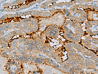 Immunohistochemistry of paraffin-embedded Human thyroid cancer tissue using ENKD1 Polyclonal Antibody at dilution of 1:75 (×200)