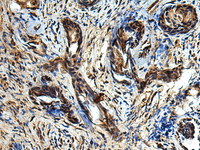 Immunohistochemistry of paraffin-embedded Human prost at e cancer tissue using TBCC Polyclonal Antibody at dilution of 1:80 (×200)