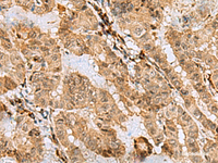 Immunohistochemistry of paraffin-embedded Human thyroid cancer tissue using ASNA1 Polyclonal Antibody at dilution of 1:70 (×200)