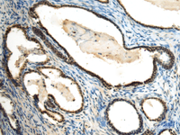 Immunohistochemistry of paraffin-embedded Human prost at e cancer tissue using SUV39H2 Polyclonal Antibody at dilution of 1:70 (×200)