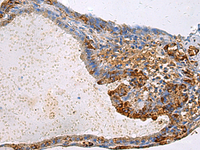 Immunohistochemistry of paraffin-embedded Human thyroid cancer tissue using GNAI1 Polyclonal Antibody at dilution of 1:100 (×200)