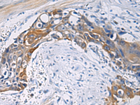 Immunohistochemistry of paraffin-embedded Human esophagus cancer tissue using CEP89 Polyclonal Antibody at dilution of 1:100 (×200)