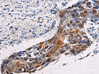 Immunohistochemistry of paraffin-embedded Human esophagus cancer tissue using SORD Polyclonal Antibody at dilution of 1:45 (×200)