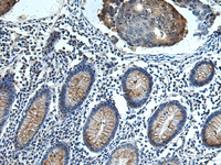 Immunohistochemistry of paraffin-embedded Human colorectal cancer tissue using FCRLA Polyclonal Antibody at dilution of 1:80 (×200)