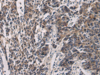 Immunohistochemistry of paraffin-embedded Human colorectal cancer tissue using CCNI Polyclonal Antibody at dilution of 1:60 (×200)