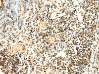 Immunohistochemistry of paraffin-embedded Human lung cancer tissue using SEPHS1 Polyclonal Antibody at dilution of 1:85 (×200)