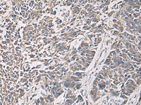 Immunohistochemistry of paraffin-embedded Human colorectal cancer tissue using PRKCSH Polyclonal Antibody at dilution of 1:90 (×200)