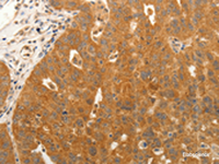 Immunohistochemistry of paraffin-embedded Human ovarian cancer tissue using CDH5 Polyclonal Antibody at dilution of 1:30 (×200)