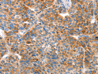 Immunohistochemistry of paraffin-embedded Human liver cancer tissue using VTN Polyclonal Antibody at dilution of 1:100 (×200)