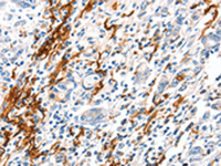 Immunohistochemistry of paraffin-embedded Human gastric cancer tissue using VTN Polyclonal Antibody at dilution of 1:100 (×200)