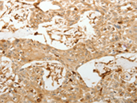 Immunohistochemistry of paraffin-embedded Human esophagus cancer tissue using VMA21 Polyclonal Antibody at dilution of 1:150 (×200)