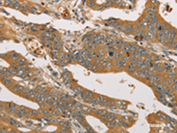 Immunohistochemistry of paraffin-embedded Human gastric cancer tissue using XPR1 Polyclonal Antibody at dilution of 1:45 (×200)