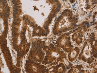 Immunohistochemistry of paraffin-embedded Human colon cancer tissue using CSNK2B Polyclonal Antibody at dilution of 1:30 (×200)