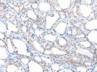 Immunohistochemistry of paraffin-embedded Human thyroid cancer tissue using PPBP Polyclonal Antibody at dilution of 1:30 (×200)