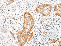 Immunohistochemistry of paraffin-embedded Human esophagus cancer tissue using HNF1A Polyclonal Antibody at dilution of 1:25 (×200)