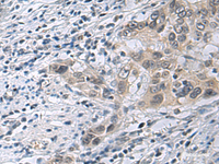 Immunohistochemistry of paraffin-embedded Human esophagus cancer tissue using IRS4 Polyclonal Antibody at dilution of 1:45 (×200)