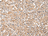 Immunohistochemistry of paraffin-embedded Human liver cancer tissue using LEPR Polyclonal Antibody at dilution of 1:30 (×200)