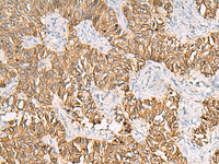 Immunohistochemistry of paraffin-embedded Human ovarian cancer tissue using SLC16A1 Polyclonal Antibody at dilution of 1:30 (×200)