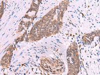 Immunohistochemistry of paraffin-embedded Human esophagus cancer tissue using MYOD1 Polyclonal Antibody at dilution of 1:50 (×200)