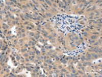 Immunohistochemistry of paraffin-embedded Human ovarian cancer tissue using P2RY6 Polyclonal Antibody at dilution of 1:40 (×200)